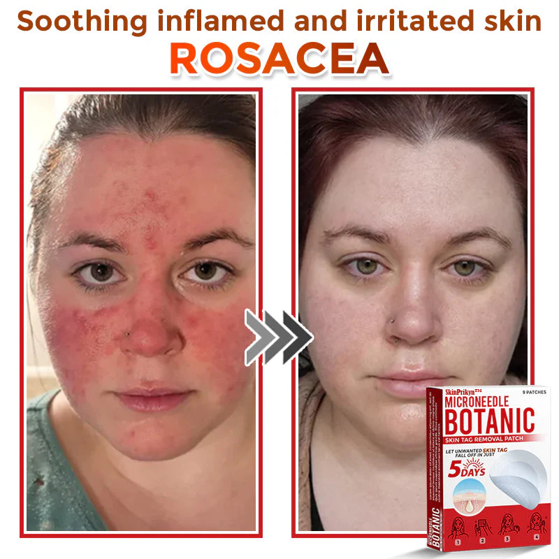 🌈 SkinPrikyn™ MicroNeedle Botanic Skin Tag Removal Patch 🇺🇸 Made in the USA